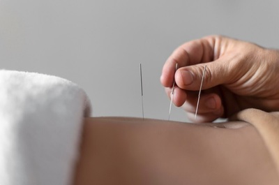 Intramuscular Stimulation (IMS)